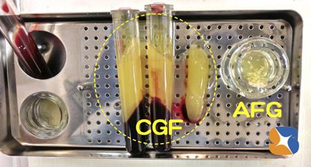 自己血液による無添加細胞培養