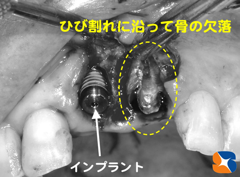 前歯2本抜いて２本インプラント植える　麻酔鎮静法　大阪