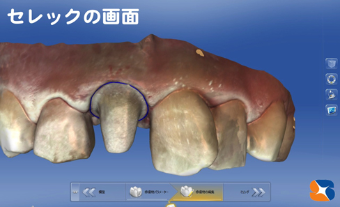 口の中をセレックで画像を読み取り