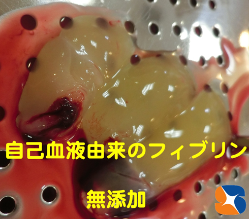 自己血液由来のフィブリンの塊　傷口の早期回復　痛みの軽減
