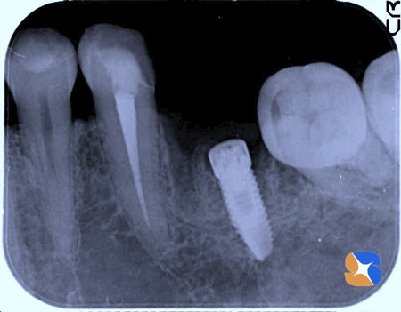 寝ながらのインプラント手術　痛みも恐さも一切なし