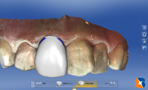 セレックのPCモニターで患者様に合った前歯を設計