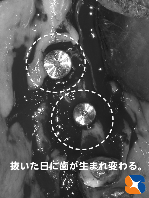 抜歯した日に歯が生まれ変わる