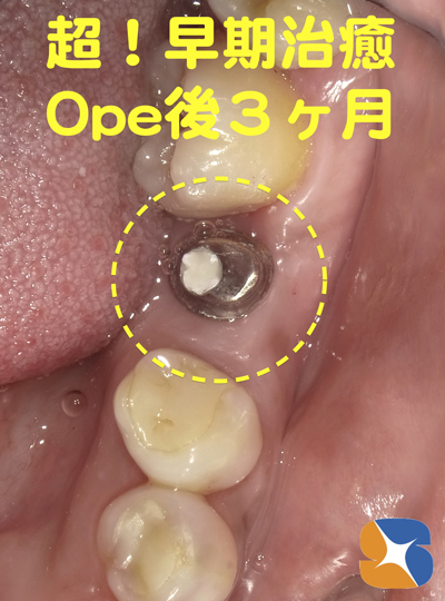 静脈鎮静法　無料サポート　抜歯とインプラント同日