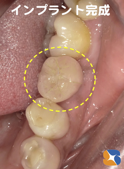 静脈鎮静法　無料サポート　抜歯とインプラント同日