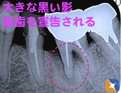 大阪市内のインプラント治療費半値