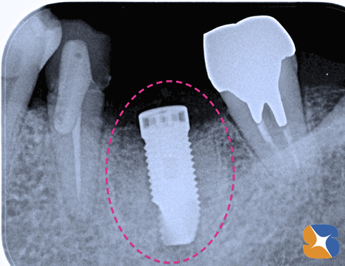 抜歯した日に新しい歯が生まれる