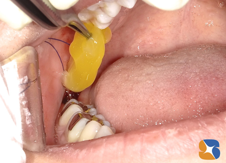 東大阪　生駒　奈良　親知らず抜歯　点滴