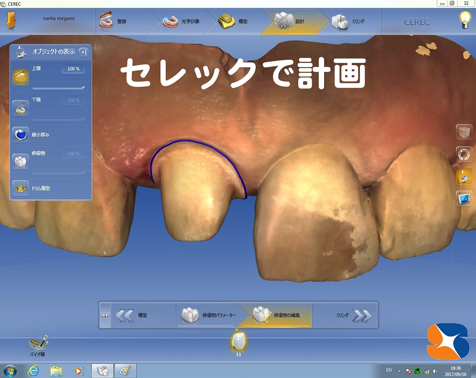セレック　院長　オールセラミックを製作　色　形　大きさ　厚み　完璧