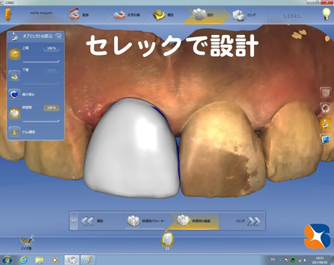東大阪　奈良　生駒　歯科　セラミック　きっちり　丁寧　完璧　低価格　50,000〜