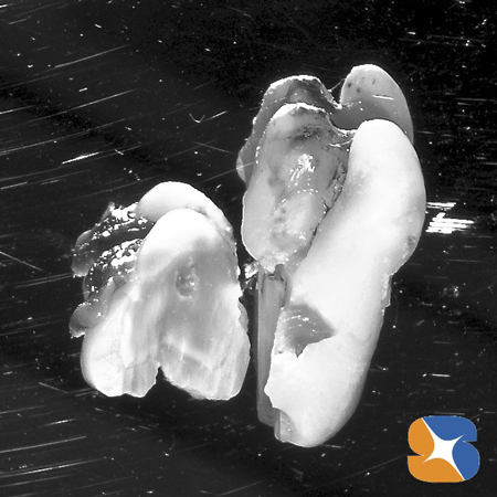 東大阪　生駒　奈良　親知らず抜歯　点滴