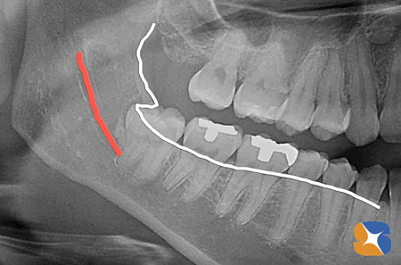 東大阪　生駒　奈良　親知らず抜歯　点滴