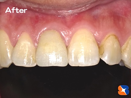 奈良　生駒　前歯　審美　キレイ