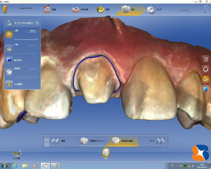 奈良　生駒　前歯　ブリッジ