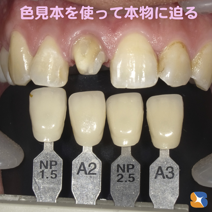 奈良　生駒　前歯　ブリッジ