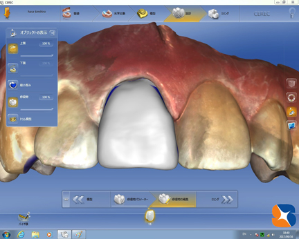 奈良　生駒　前歯　ブリッジ