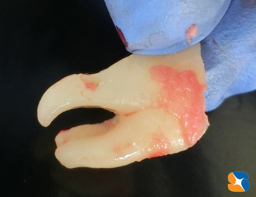 根の先も曲がりくねっていて骨を抱きこむ