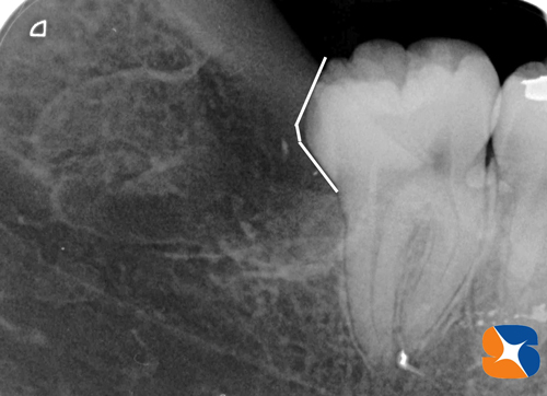 難易度の高い横向きの親知らずの抜歯