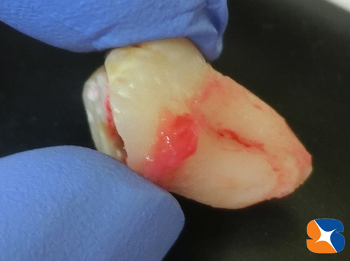 眠っている間に反対側の横向きの親知らずの抜歯