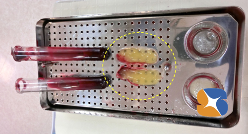 自己血液由来のフィブリノーゲン塊　無料