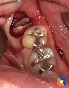 奈良　東大阪　生駒　横向きの親知らず抜歯　