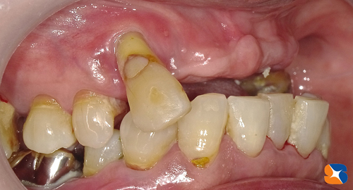 外れる入れ歯から何でも噛める固定の歯へ