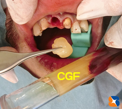 自己血液を使って再生療法