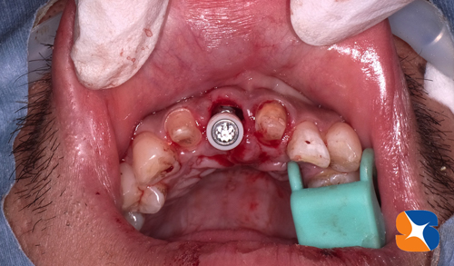 抜いた日にインプラントを植立　手術は１回