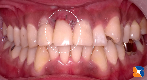 審美を考慮したインプラント移植