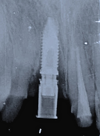 歯を抜いた日に骨を増強させてからインプラントを移植