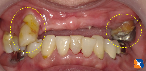 歯を抜いた日に歯を移植する