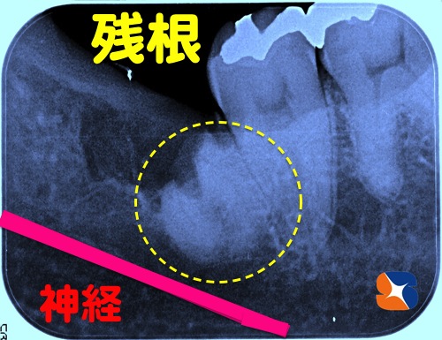 下顎に残された頑丈な親知らずの根