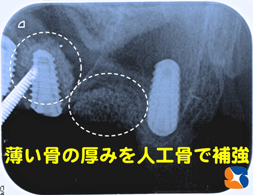 骨の厚みの薄い所に人工的に骨を作る