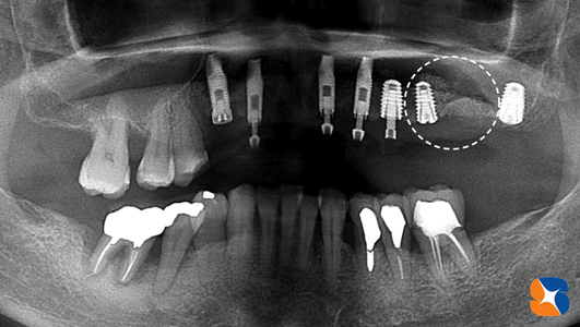 最新方法のインプラント手術　再生療法