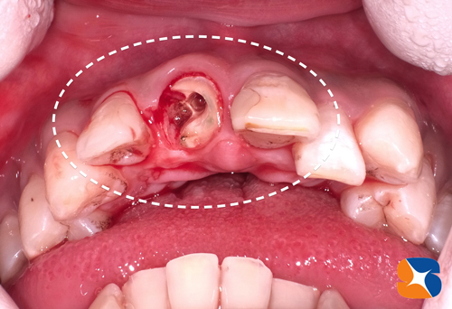 事故で歯を失う