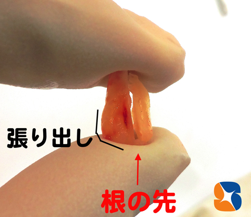 根の先が五角形になっているため抜歯困難