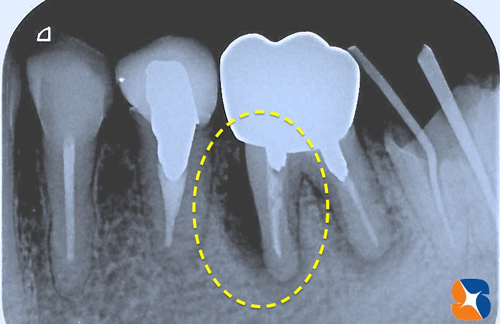 奥歯に大きな膿みの袋　抜歯を宣告
