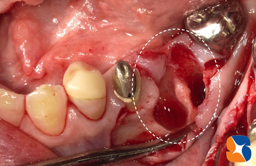 一日で抜歯＋インプラント植立＋骨の強化