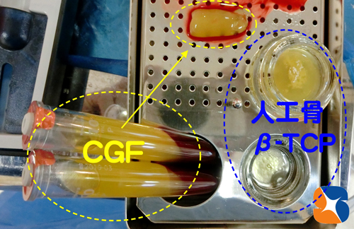 人工骨　CGF　AFG