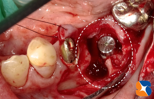 一日で抜歯とインプラント植立＋骨を作る
