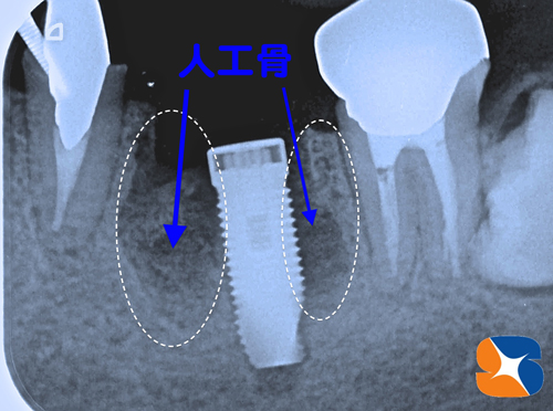 一日で抜歯とインプラント植立と骨の増強