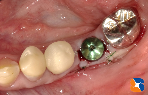 インプラント植立