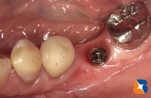 インプラント植立から３ヶ月で歯の復活