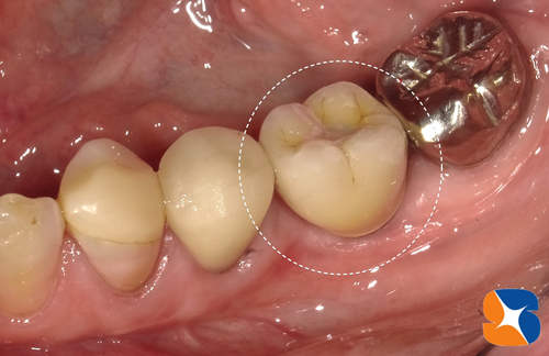 インプラント治療の最先端