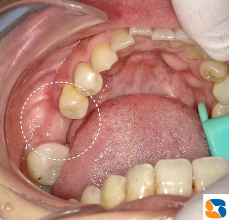 眠りながら痛まない腫れないインプラント