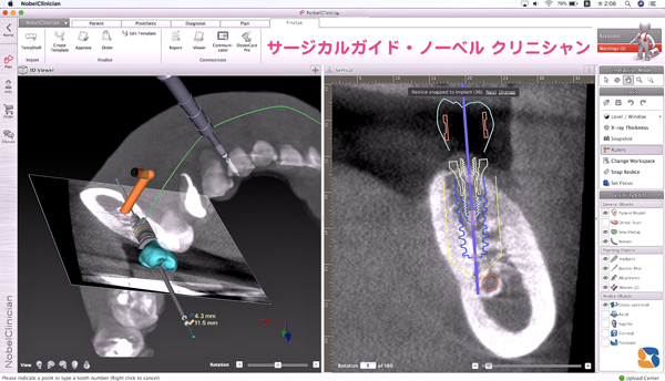海外では常識のインプラント器具サージカルガイド