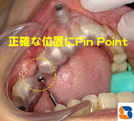 眠りながら痛まない腫れないインプラント