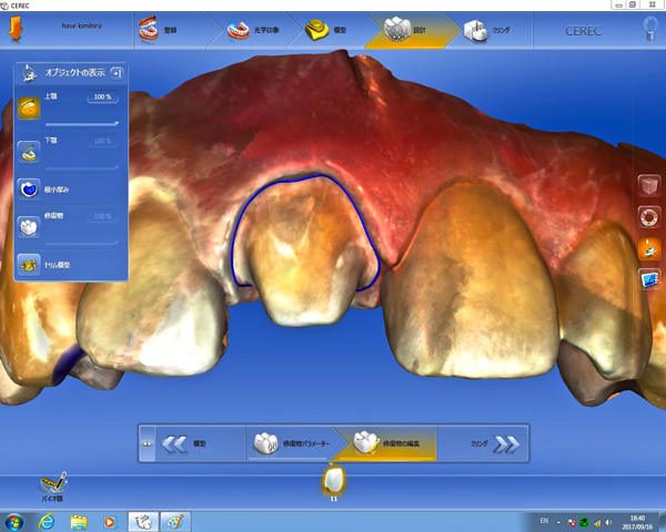 前歯をPCで作る時代　ティース teethナビゲーション