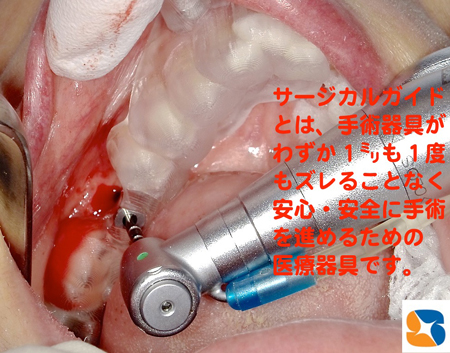 眠りながら痛まない腫れないインプラント