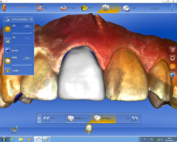 歯をPCで作る時代　ティース teethナビゲーション
